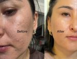 1756803388 celimaxbeforeafter original